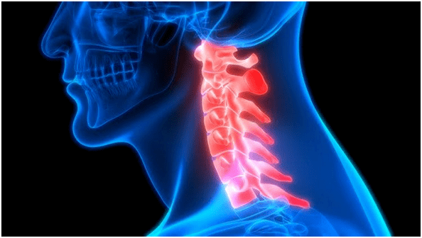 Nackenschmerzen führen zu Rückenschmerzen