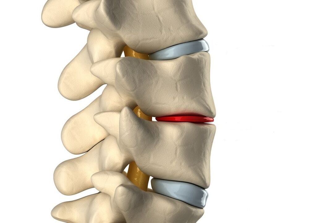 Gesunde (blau) und geschädigte Bandscheibe aufgrund thorakaler Osteochondrose (rot)
