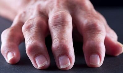 Was ist der Unterschied zwischen Arthritis durch Arthrose