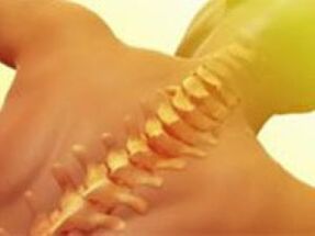 Osteochondrose - Wirbelsäulenerkrankung