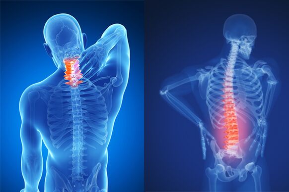 Osteochondrose der Hals- und Lendenwirbelsäule