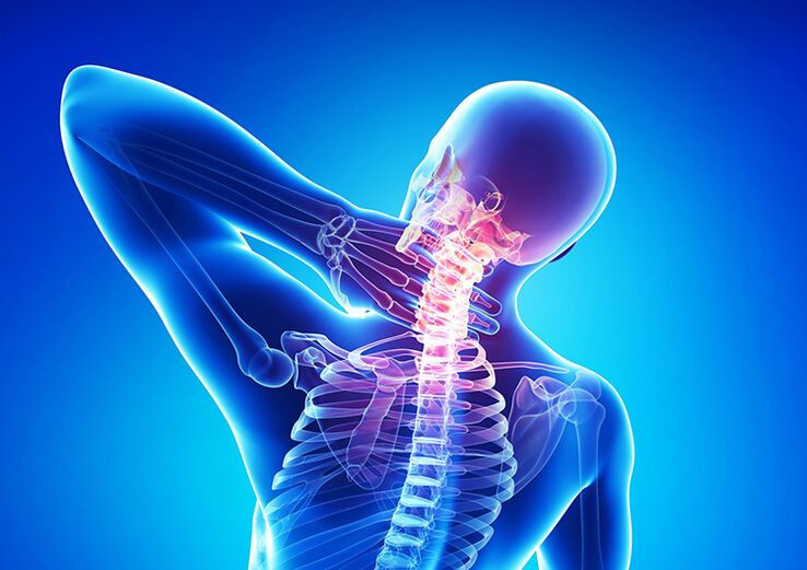 Spinale Osteochondrose ist eine Erkrankung, die den Gelenkknorpel und die Wirbel betrifft.
