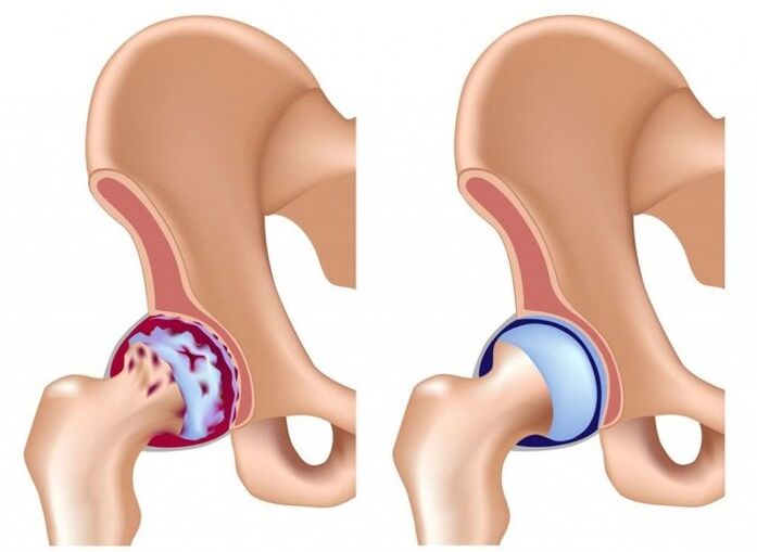Schädigung des Hüftgelenks durch Arthrose