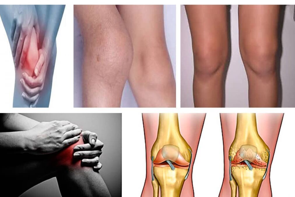 Arthrose, was ist das