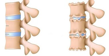 Wie man das Vorhandensein von Osteochondose der Lendenwirbelsäule erkennt