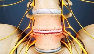 die Hauptsymptome der zervikalen Osteochondrose